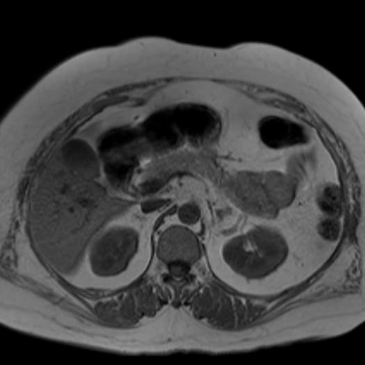 снимок МРТ органов брюшной полости